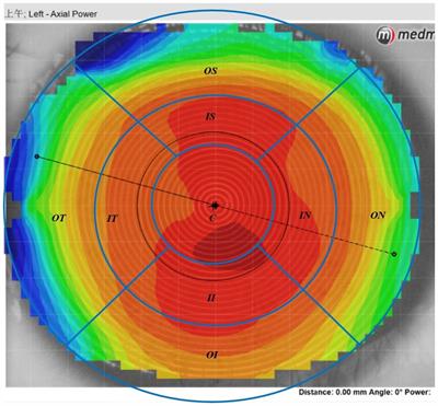 The correlation between modifications to corneal topography and changes in retinal vascular density and retinal thickness in myopic children after undergoing orthokeratology